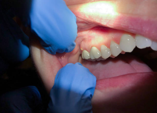Best Emergency Treatment for Oral Infections in Wathena, KS
